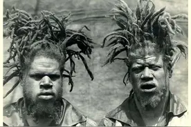 身为黑人却得白化症，兄弟俩从小被拐卖，开启了辛酸的人生经历图片