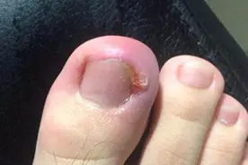 指甲长肉里了别着急，在家几毛钱教你解决，方法简单，实用又省钱视频封面