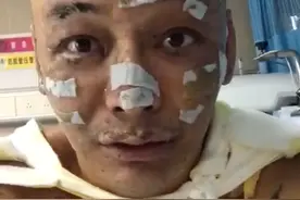 早日康复！歌手自曝因点燃香薰蜡烛引发火灾，全身二级深度烧伤图片