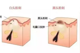 什么是闭口粉刺？闭口粉刺怎么祛除？图片
