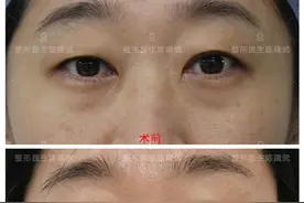 同姐妹们分享：做完双眼皮+祛眼袋，感觉年轻了5岁图片