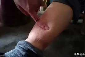 尿酸高的人，身体若出现这4种异常，患者应警惕，肾衰竭要来了图片