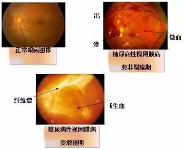 甲钴胺不仅能修复受损神经，还能用于这3种常见病的治疗，好用