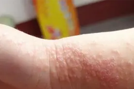 过敏性皮炎不能吃什么食物？这种肉食会加重过敏反应视频封面