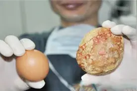 肇庆60岁阿婆吃辣椒40余年，体内长出1斤重结石视频封面