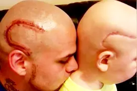 为了不让儿子自卑，父亲在脑袋上纹了一个一模一样的疤痕视频封面