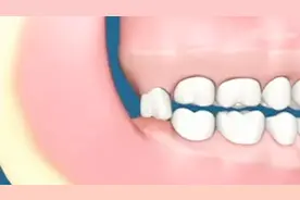 3D动画演示拔智齿过程，看千奇百怪的智齿，是怎么让你疼痛难耐的