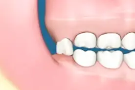 3D动画演示拔智齿过程，看千奇百怪的智齿，是怎么让你疼痛难耐的视频封面