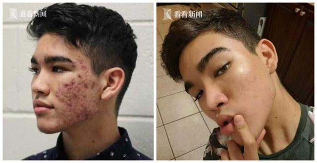 16岁男孩DIY护肤流程治好痤疮 专业医生表示惊讶与认可