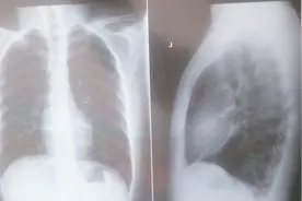 左肋骨下方隐隐疼痛是怎么回事？病因有哪些？视频封面