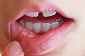 口腔溃疡疼痛难忍，找点它含在嘴里，2天就可痊愈，果断收藏！