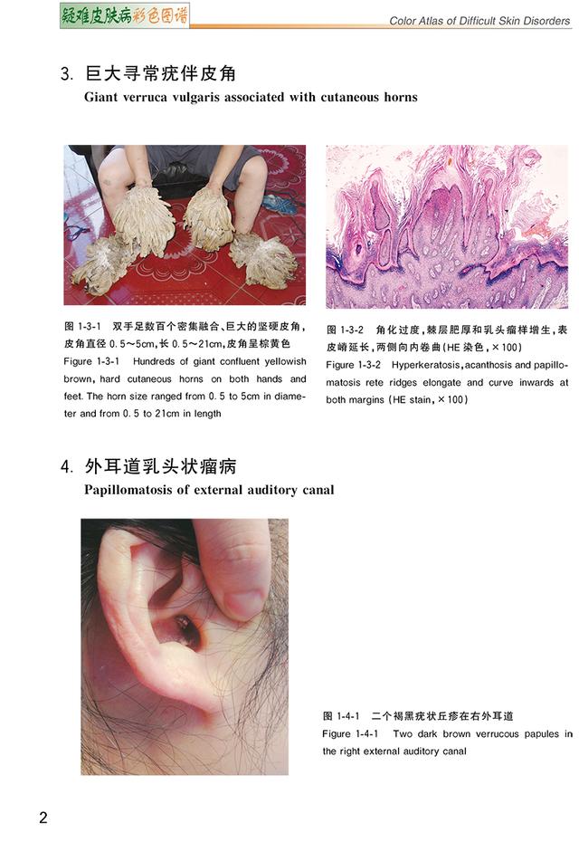 汗孔角化症中草药