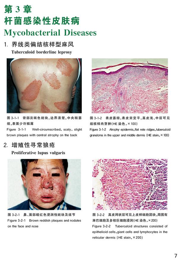 汗孔角化症中草药