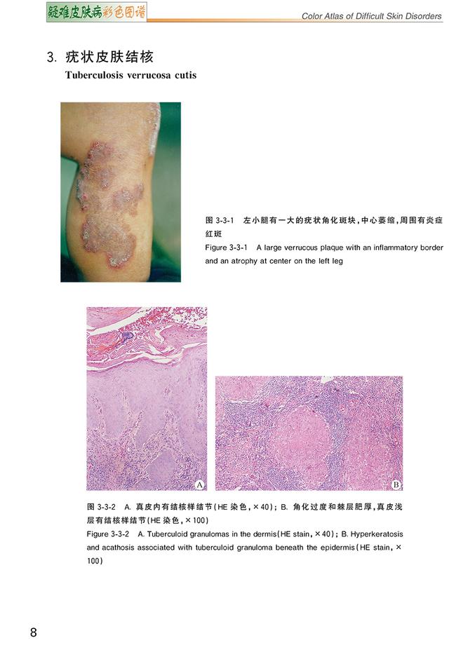 汗孔角化症中草药