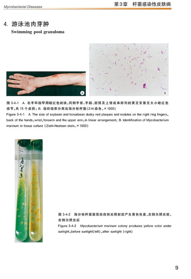 汗孔角化症中草药