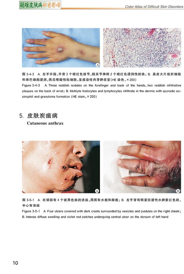 汗孔角化症中草药