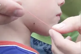 被蜱虫咬：你怎么做？有人竟然想用注射器将皮肤内的蜱虫给吸出来视频封面