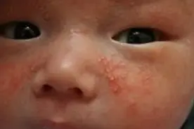 小孩子总喜欢挠自己的脸蛋，原来是“它”惹的祸，宝妈不可大意！