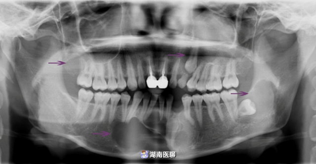 下列可能是牙源性角化囊肿