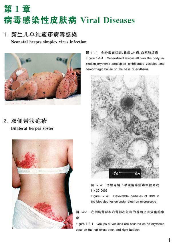 汗孔角化症中草药