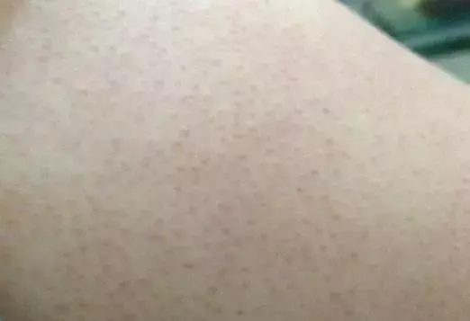 手臂长了鸡皮疙瘩