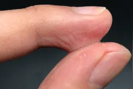 502胶水滴在皮肤上不用愁，只需滴点它，再强力的胶水都能融化视频封面