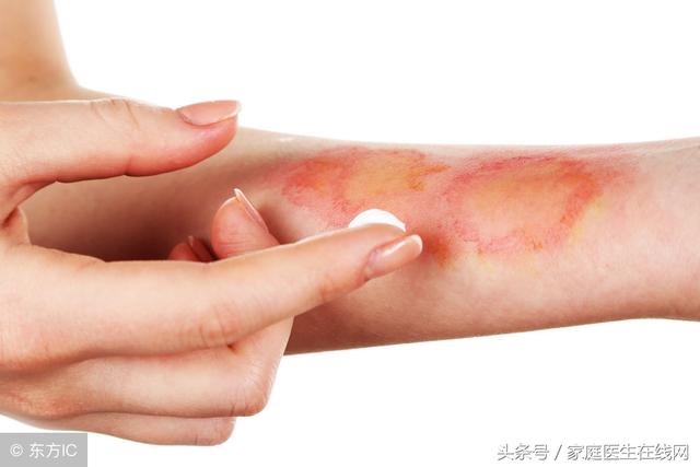 烫伤伤口痒怎么办