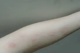 发烧时间短但退烧后浑身起红疹子是怎么回事？医生说要小心这种病