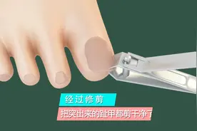 3D演示：怎样剪脚趾甲，才不会长肉里？视频封面