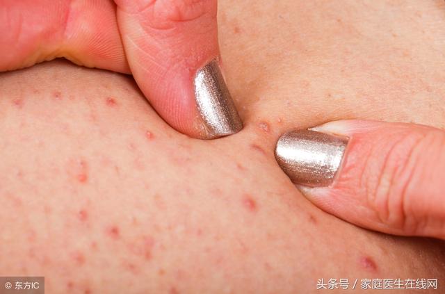 脖子脂肪粒