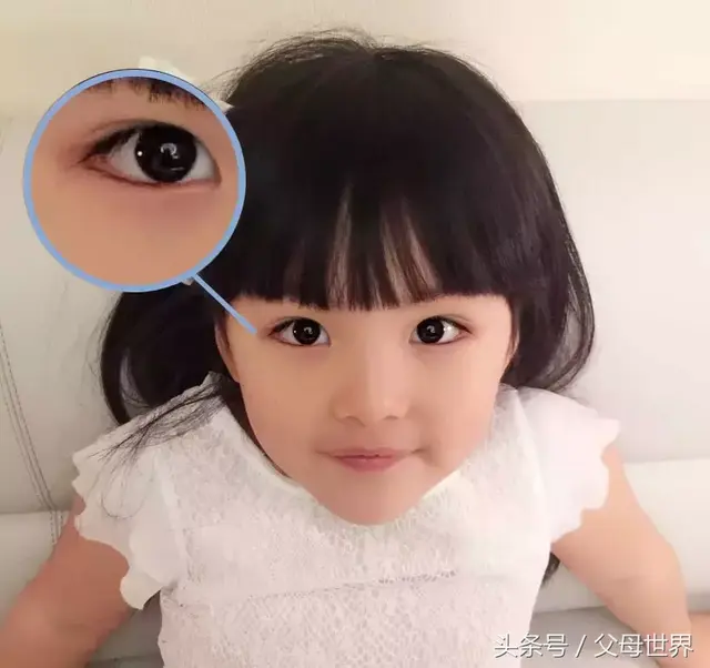 蒙古褶是啥？宝宝长了蒙古褶眼睛就会不好看吗？妈妈快来看看吧