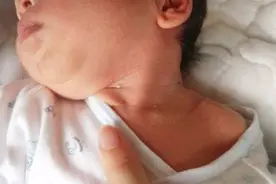 宝宝出现脖子红是怎么回事？家长别慌，儿科医生教你如何护理！视频封面