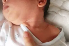 宝宝出现脖子红是怎么回事？家长别慌，儿科医生教你如何护理！
