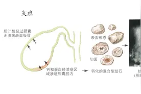 胆囊炎患者要注意了，这些是不能吃的，会刺激胆汁的分泌