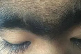 14岁女孩乱吃东西，体内激素紊乱，导致身上长了很多汗毛胡子视频封面