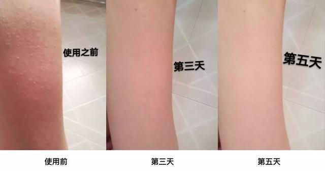 咳嗽时两腿出鸡皮疙瘩是咋回事 咳嗽时两腿出鸡皮疙瘩是咋回事