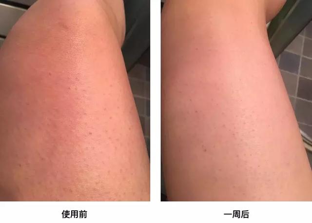 咳嗽时两腿出鸡皮疙瘩是咋回事 咳嗽时两腿出鸡皮疙瘩是咋回事