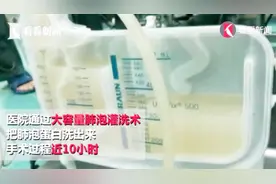 吸烟50年 老伯肺里洗出40瓶“牛奶” 老烟民们该引以为戒了！视频封面