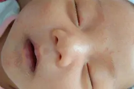 2大原因导致宝宝湿疹！妈妈提前避开，别让宝宝遭罪！视频封面