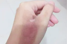 手被烫伤最怕留疤？医生朋友教了我一招，快速处理不留疤痕！视频封面