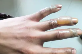 烧菜被油烫伤了别着急，用它抹一抹止痛不留疤，学会终身受用视频封面