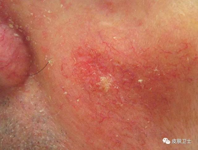 日光性角化病治愈后饮食注意事项