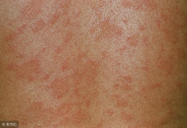 玫瑰糠疹病发与什麽有关系，有什麽病症