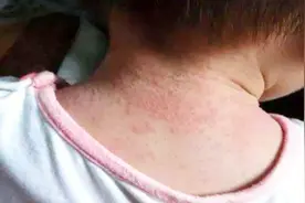 夏天起痱子怎么办？奶奶教我一个祖传老偏方，痱子全消失百试百灵