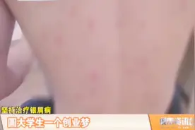 大学生身上起小红点没注意 不料得了银屑病蔓延全身视频封面
