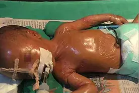 太罕见！印度妈妈产下罕见“塑料婴儿” 全身蜡状有光泽！视频封面