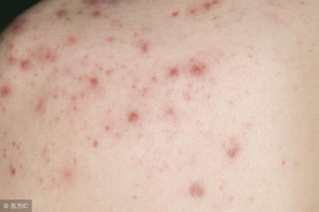 鱼鳞病中医辨证论治