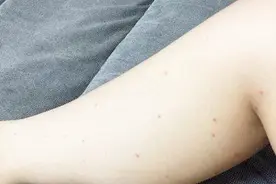 身上有小红点是怎么回事？视频封面