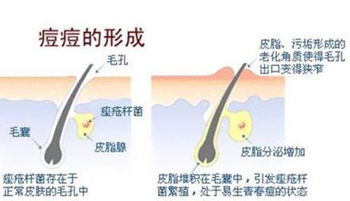 后背皮肤成片角化