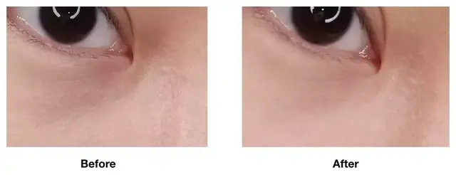 吃苹果下巴上起鸡皮疙瘩